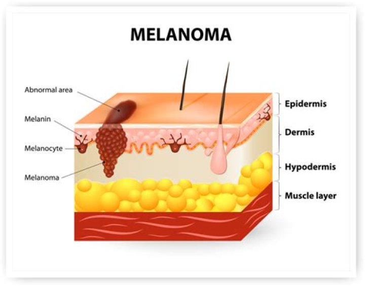 Can melanoma spread after being removed?