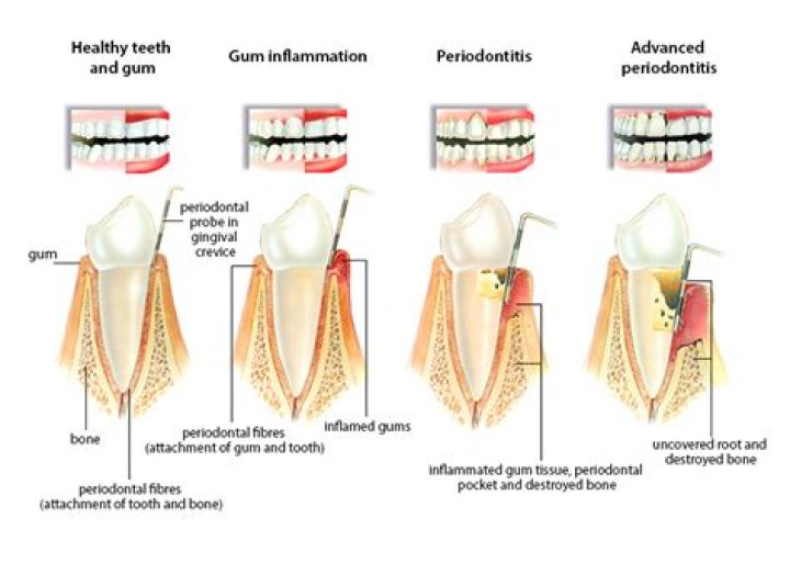 Can teeth be saved with periodontal disease?