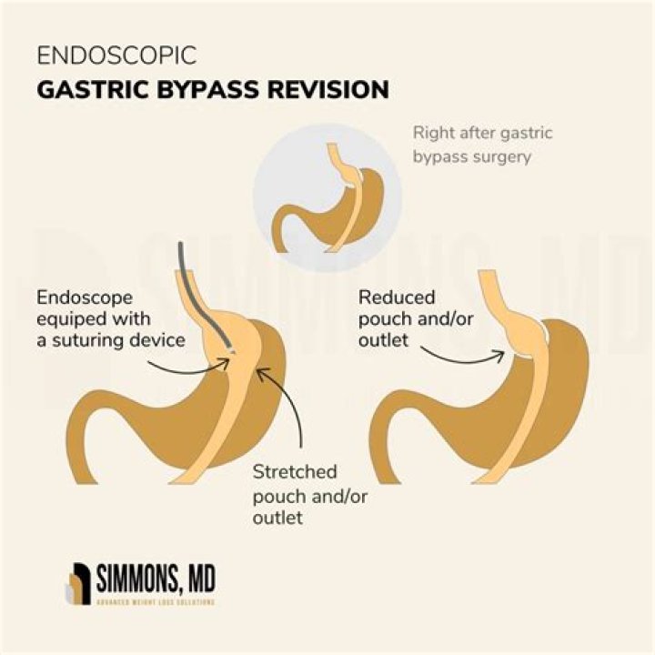 Can you refuse bypass surgery?