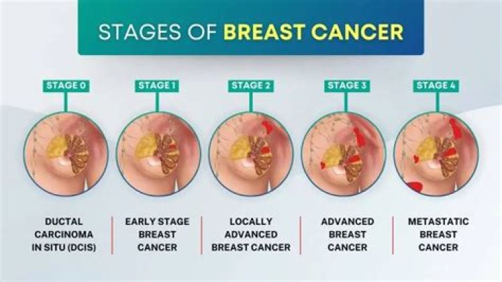 How common is breast cancer at 49?