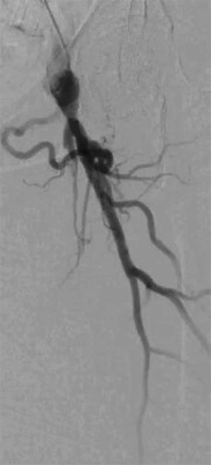 How easy is it to break a femur?