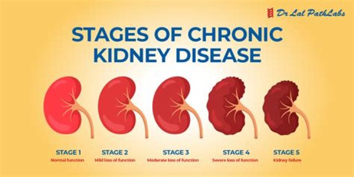 How long can you live with untreated kidney failure?
