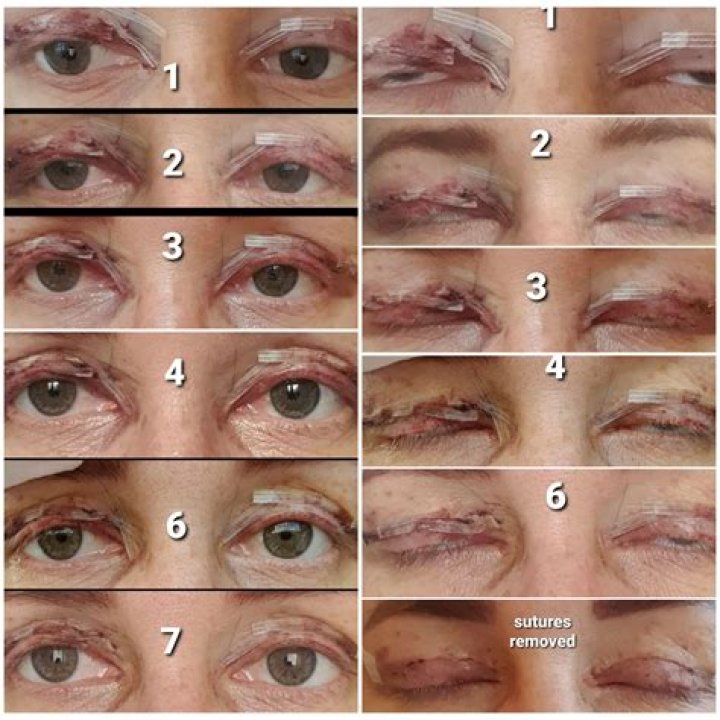 How To Speed Up Recovery After A Blepharoplasty Procedure
