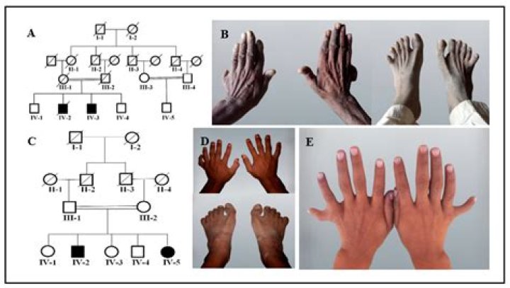 Is having an extra finger genetic?