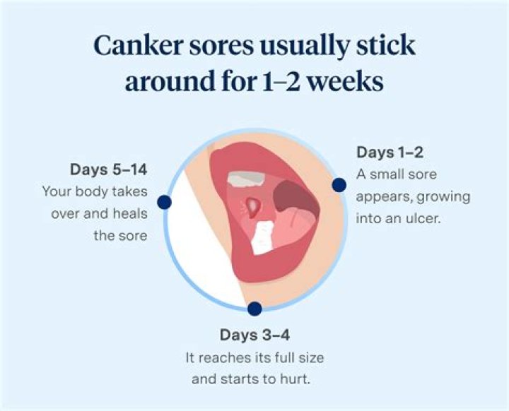 What are the stages of canker sores?