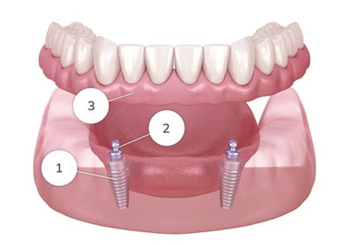 What dental category do implants fall under?