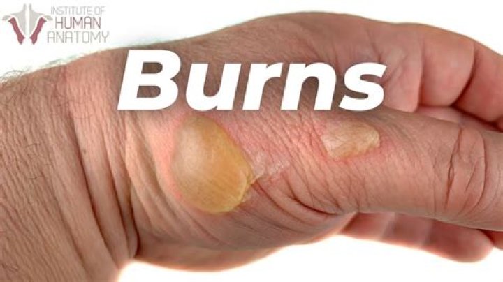 What happens when apartment burns?