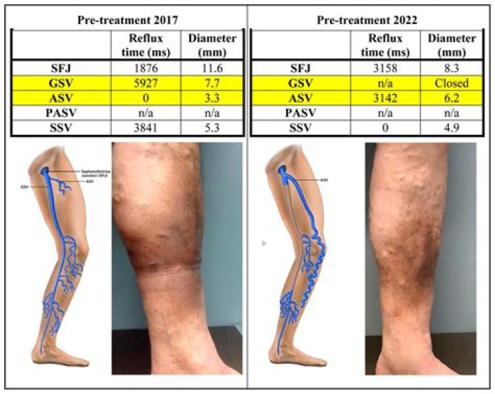 What is the difference between NSV and GSV?
