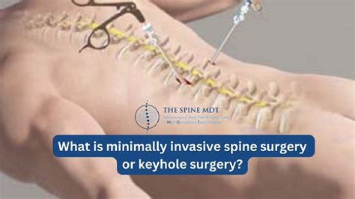 What qualifies you for back surgery?