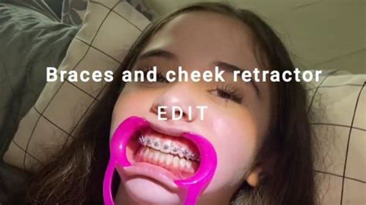 What to get your friend when she gets braces?